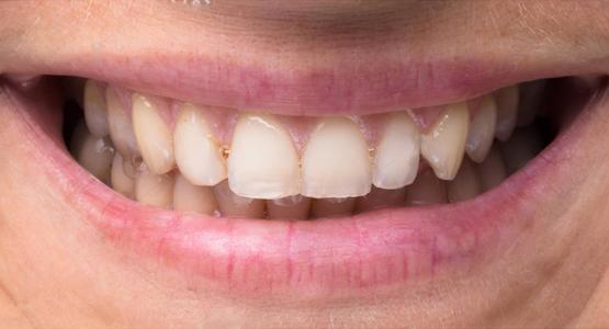 Teeth Whitening or Retouching