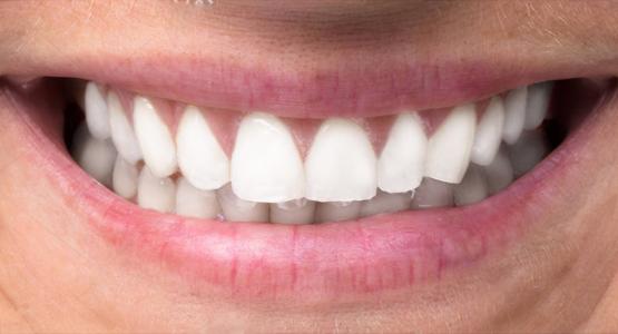 Teeth Whitening or Retouching